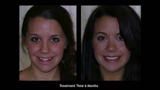 How Does Rapid Orthodontics Work? Adult Invisalign Alternative