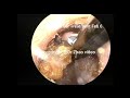 3 simple cholesteatoma clearance in the external auditory canal, 10 min