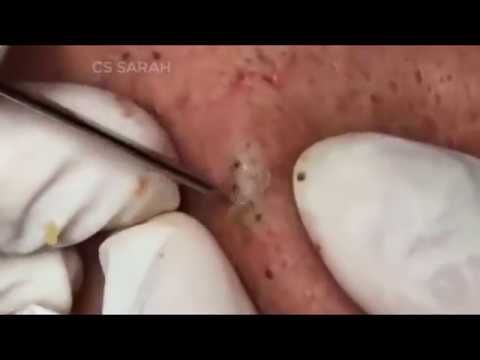 Blackhead Removable #   [zit cystic acne cystic acne extraction ance cystic acne removal]