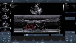 Video 2  How to perform basic echocardiographic measurements   EPSS