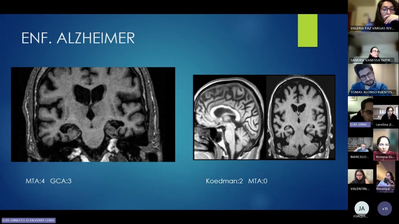 Patrones de atrofia cerebral
