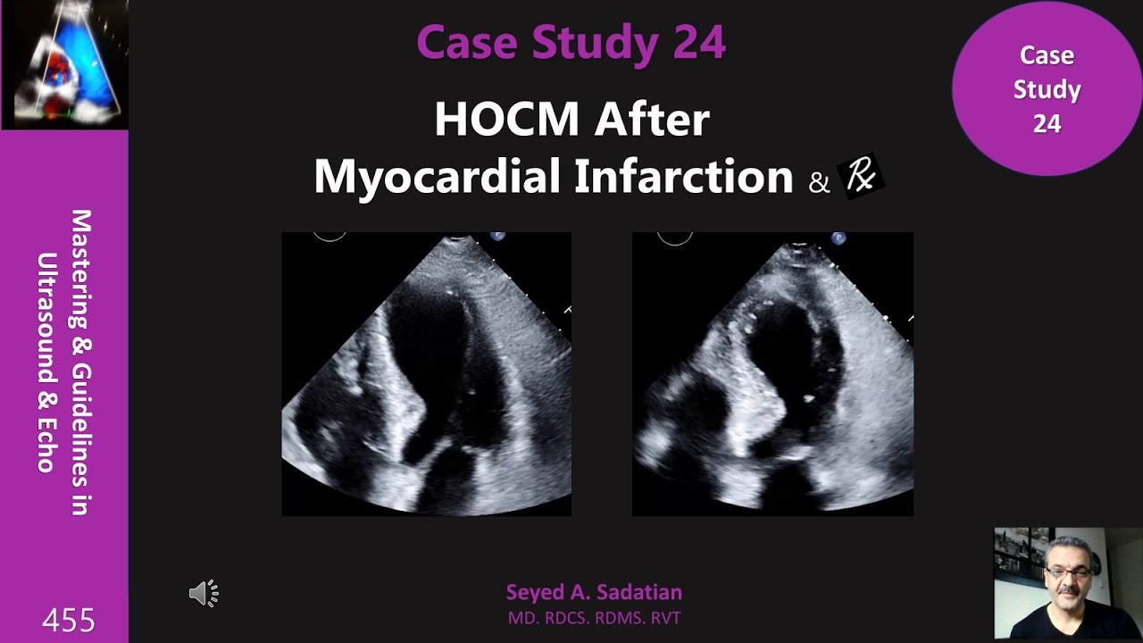 Case Study 24: HOCM After Myocardial Infarction & management