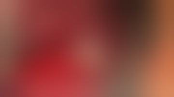 Shield technique using maxgraft® cortico (botiss biomaterials). Surgery by Viktor Kalenchuk