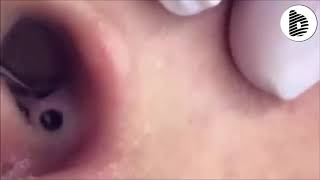 Blackhead Removal in Ear