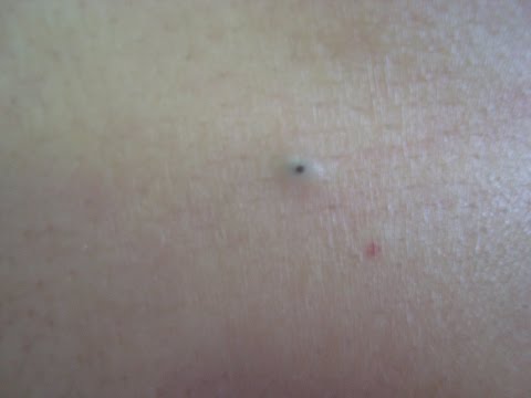 Dilated Pore Treatment
