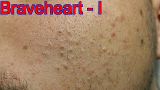 Extraction for Teenage Acne - Part 1 of 3