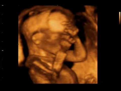4d Ultrazvuk 18 Nedelja 4d Ultrasound 18 Week Youtube 4d Ultrazvuk 18 Nedelja 4d Ultrasound 18 Week Youtube