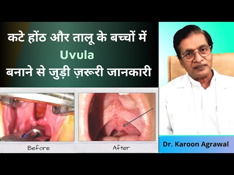 कटे होंठ और तालू के बच्चों में Uvula बनाने से जुड़ी ज़रूरी जानकारी | Uvula in Cleft Palate in Hindi