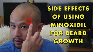 9 Side Effects That I Experienced in My Minoxidil Beard Growth Journey