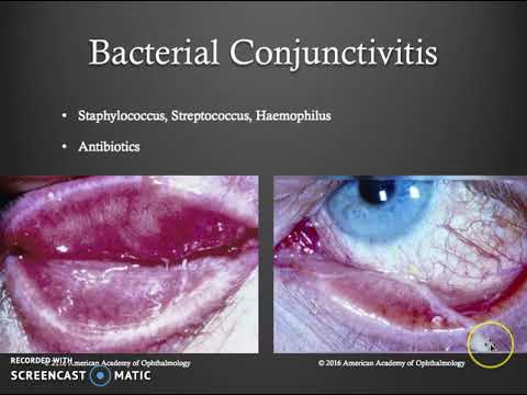 Video: Forskjellen Mellom Sclera Og Conjunctiva