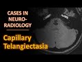 Cases in neuroradiology capillary telangiectasia