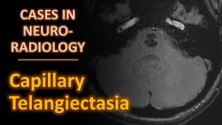 Cases in Neuroradiology: Capillary Telangiectasia