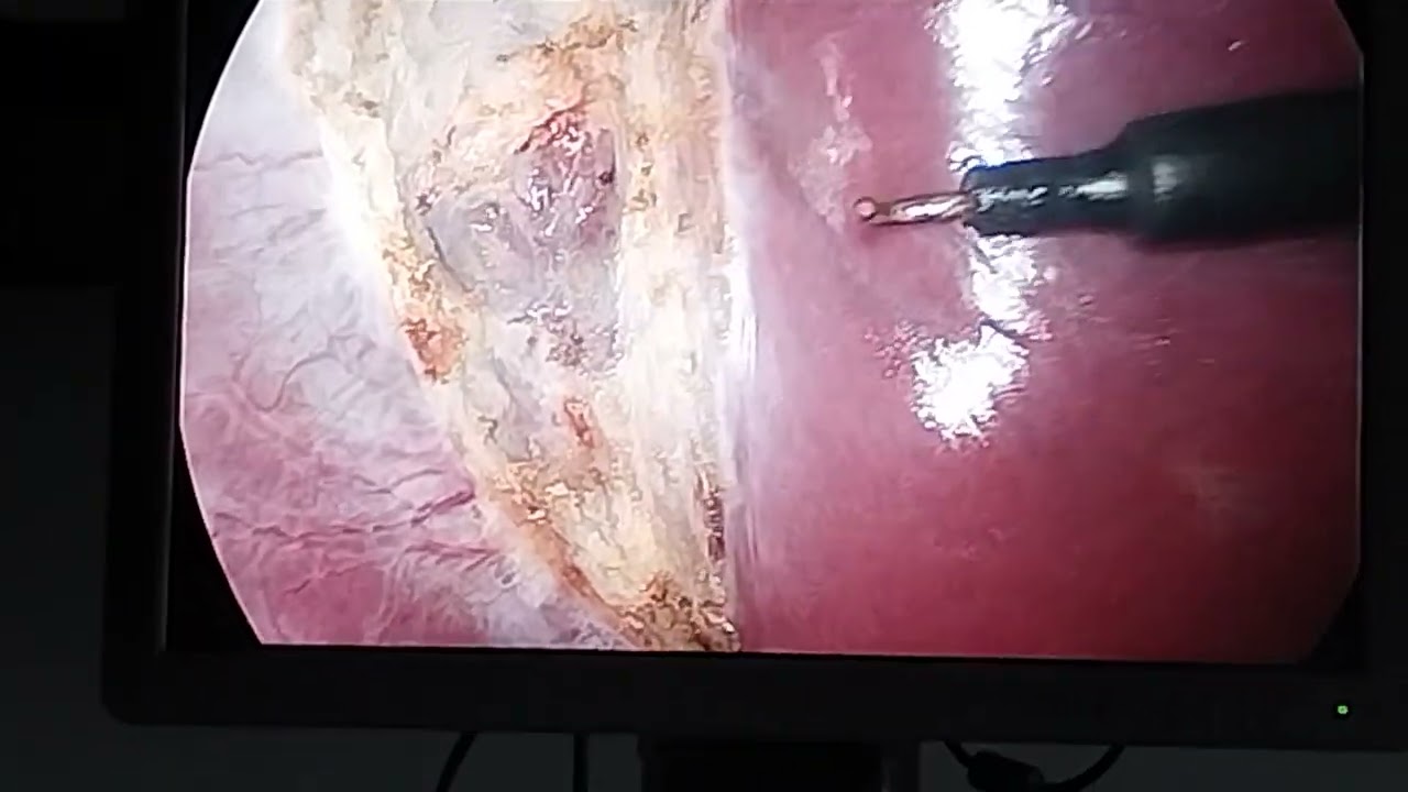 critical view of safety in laparoscopic cholecystectomy @drvikrantsinghchandail