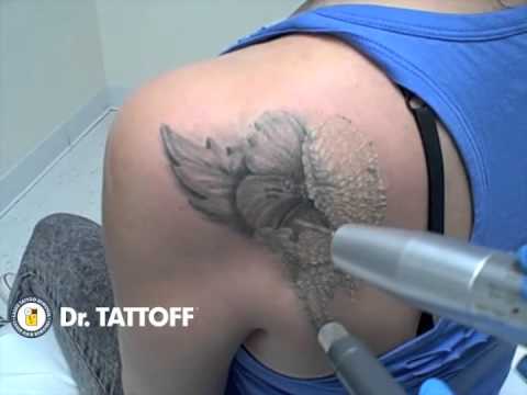 Painless Tattoo Removal Los Angeles Beverly Hills CA