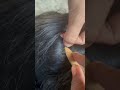 #fypviralシ #statisfying #lice #hair #LiceOnHead #liceremoval #brasil #xyzbcafyp #licecomb #kutu