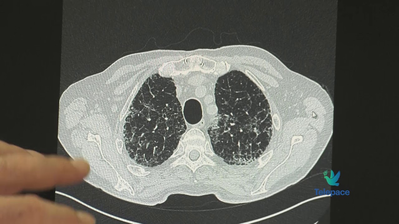 I problemi del long Covid