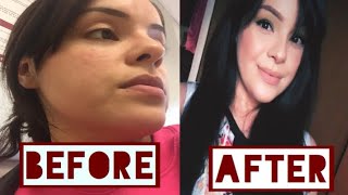 How to clear your face of facial inflammation and acne fast DRUG STORE Target products!! Clear Skin