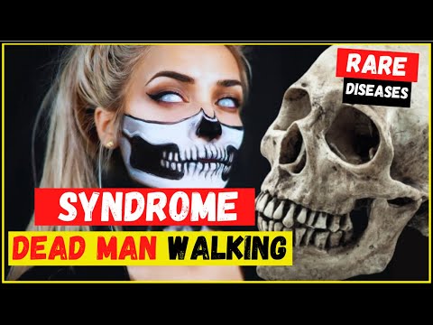 Cotard&rsquo;s syndrome/syndrome dead walking: what is? symptoms, causes and treatment - Most rare disease