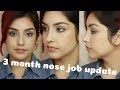 NOSE JOB Q&A  | How much did it cost???? + 3 month Update