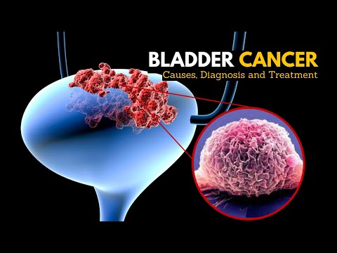Video: Eine Gescheiterte Strategie Für Ein Wirksames Blasenkrebsmedikament