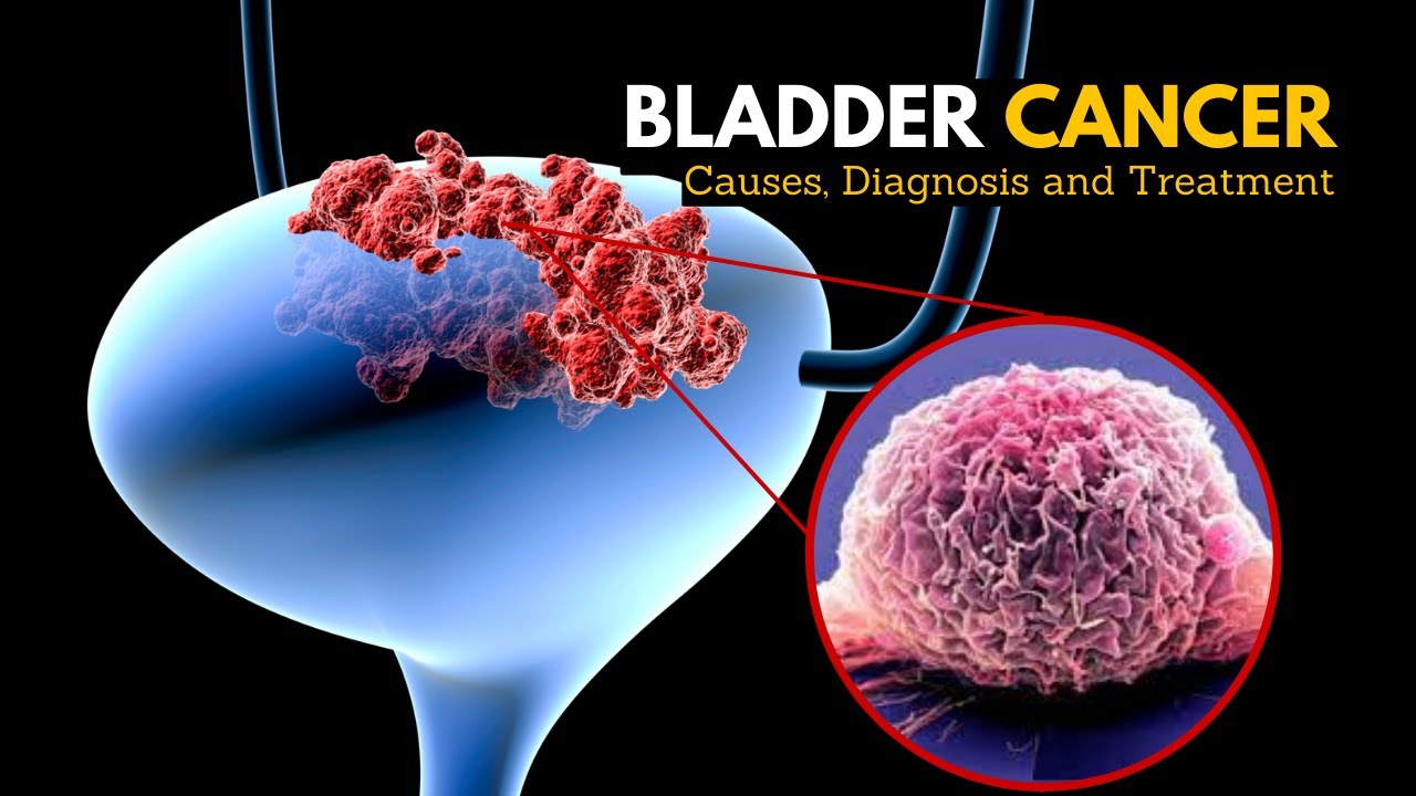 Bladder Cancer, Causes, Signs and Symptoms, Diagnosis and Treatment