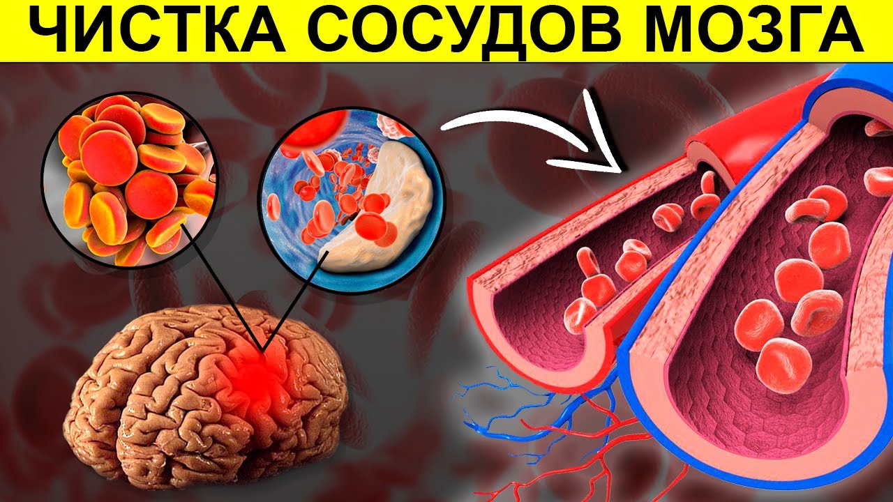 Головного мозга атеросклероз народное средство. Очищение сосудов. Атеросклероз чистка сосудов. Атеросклероз сосудов головного мозга.