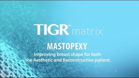 TIGR Matrix 3D movie Mastopexy**