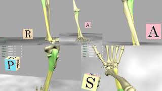 【発生機転】Monteggia脱臼骨折