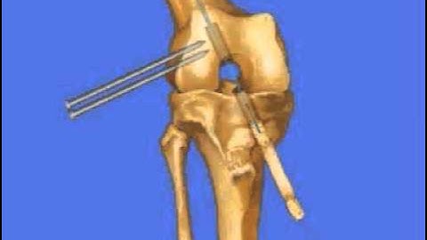 BTB Rigidfix - Dr. Daniel Biggs