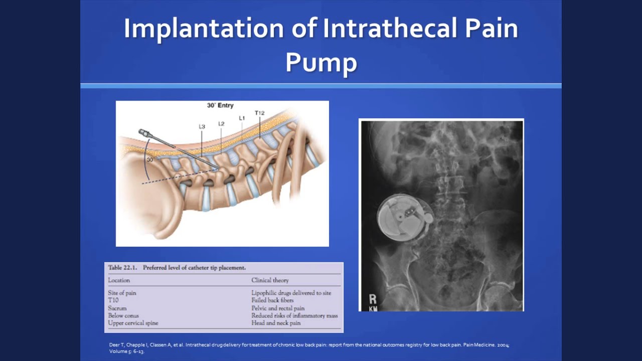 Irene I-Lan Wu, MD - The Role of Adjuvant Pain Therapy, such as Intrathecal Drug Delivery...