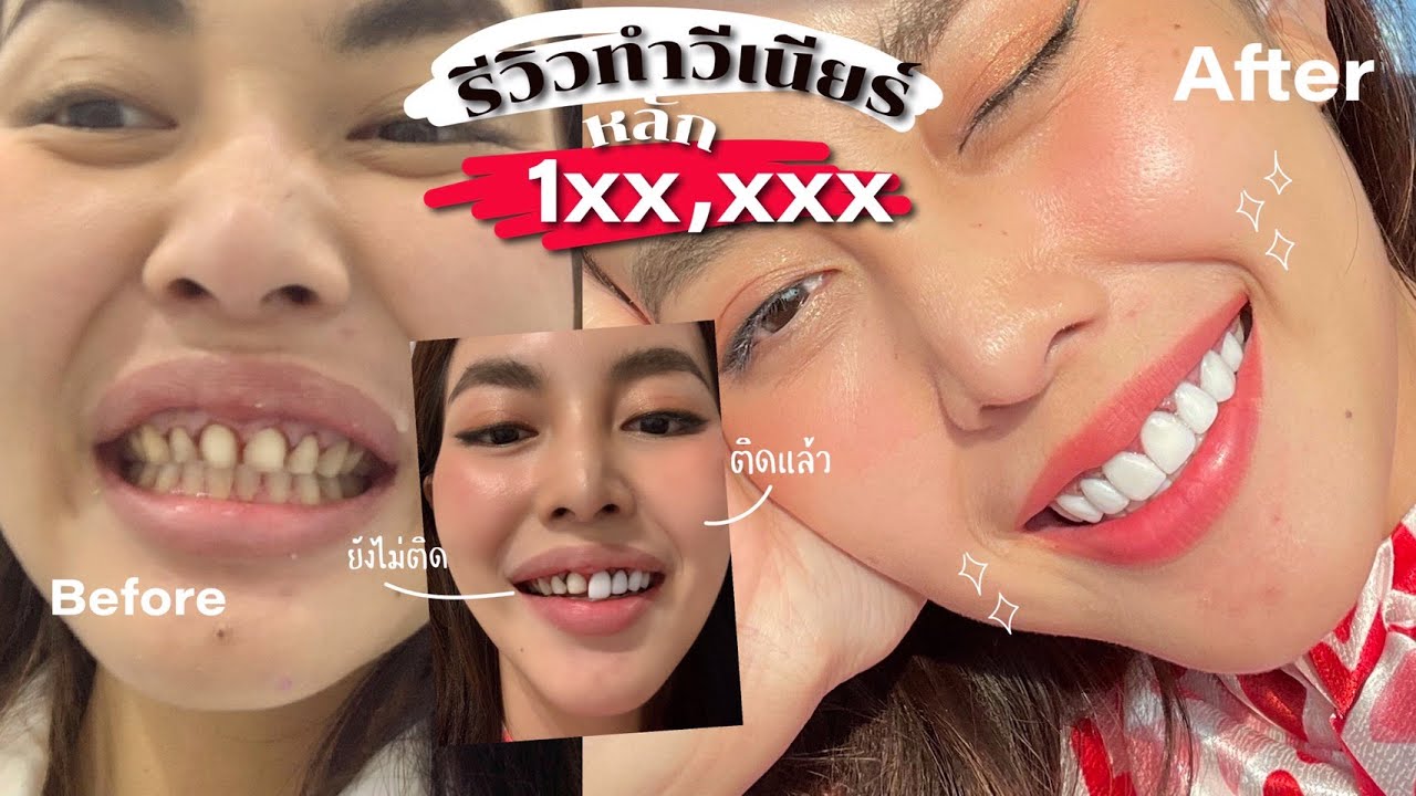 รีวิวทำวีเนียร์แปะฟันขาว ตัดเหงือก  ราคา 1xx,xxx บาท ?! |Bew varaporn