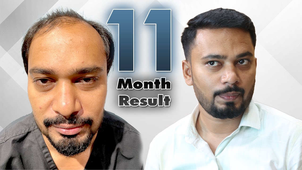 4500+ Grafts | Before After Hair Transplant Results vs Finasteride | Dr. Vivek Galani | RQC