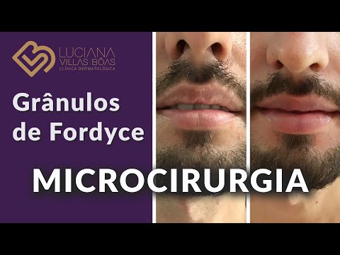 Vídeo: Urofoscin - Instruções De Uso, Preço, Comentários, Análogos De Grânulos