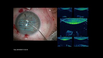 DMEK - Graft unfolding Technique