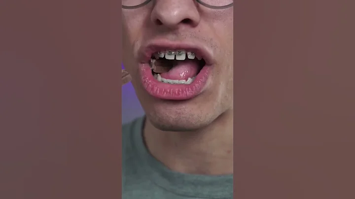 1 month of braces #transformation - DayDayNews