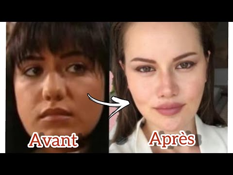 6 ACTRICES TURQUES QUI ONT FAIT LA CHIRURGIE PLASTIQUE POUR ÊTRE BELLE😱😰