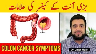 Bari Aant Ka Cancer Ki Alamat | Colon Cancer Symptoms, Signs of Colon Cancer, Bowel Cancer Ki Alamat