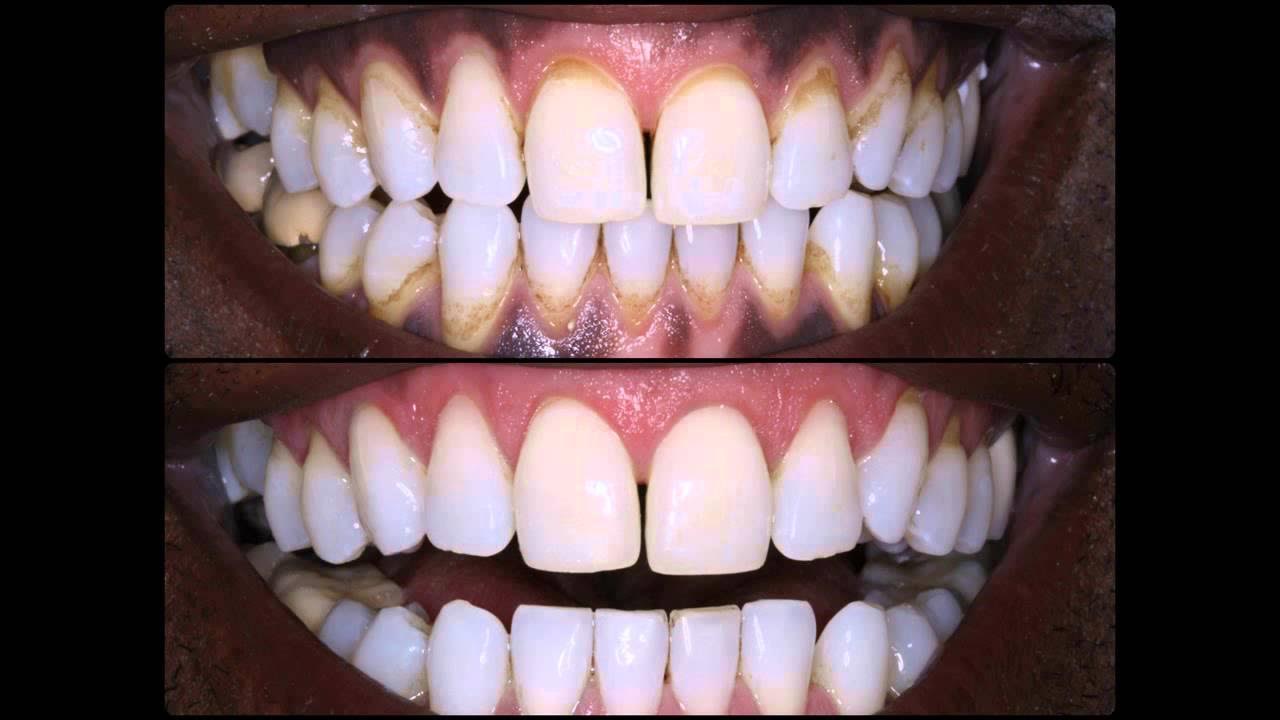 Épinglé sur Dents