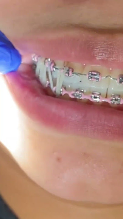 What does a reverse curve wire do for braces? 1 Month Check Up