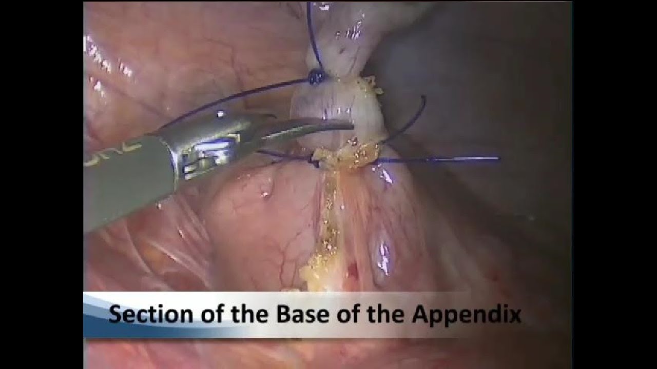 Appendicitis Children 12 years YouTube