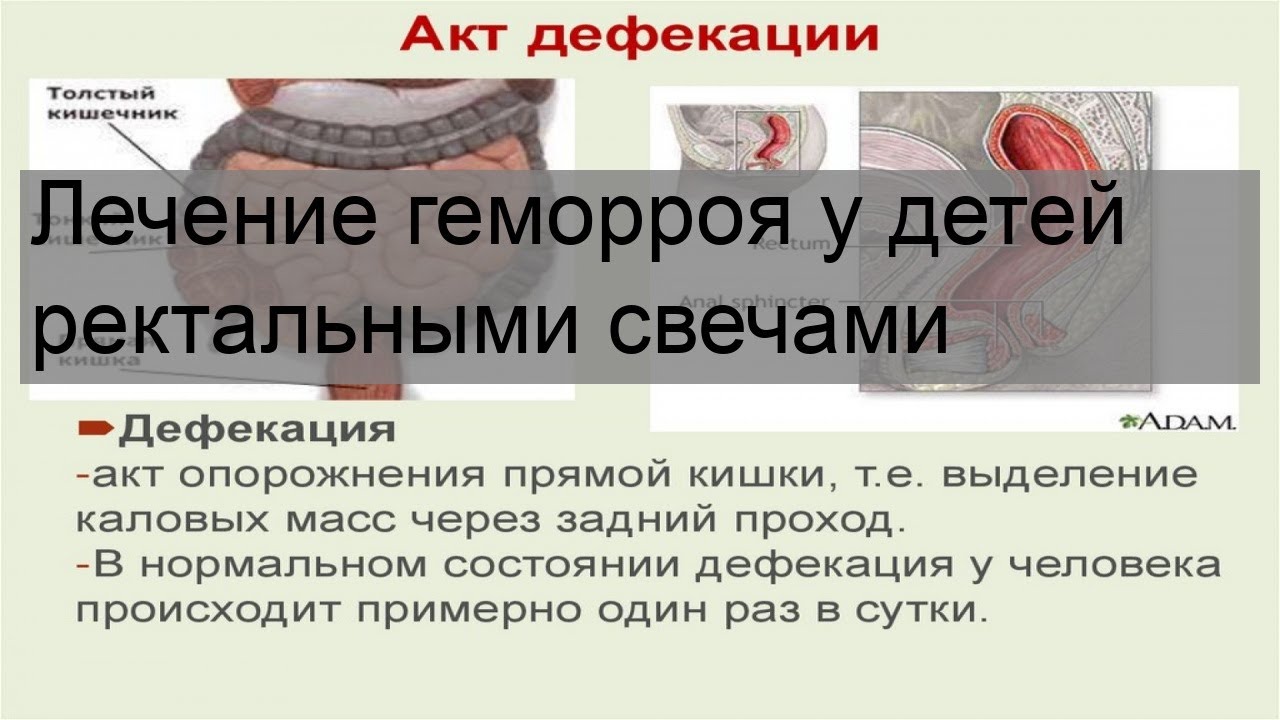 Лечение геморроя у детей ректальными свечами