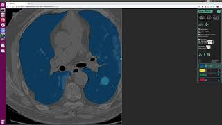Segmentation of lungs on CT start to finish in the web-browser.