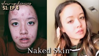 Acne to clear skin journey | Glow up Diaries Episode 4