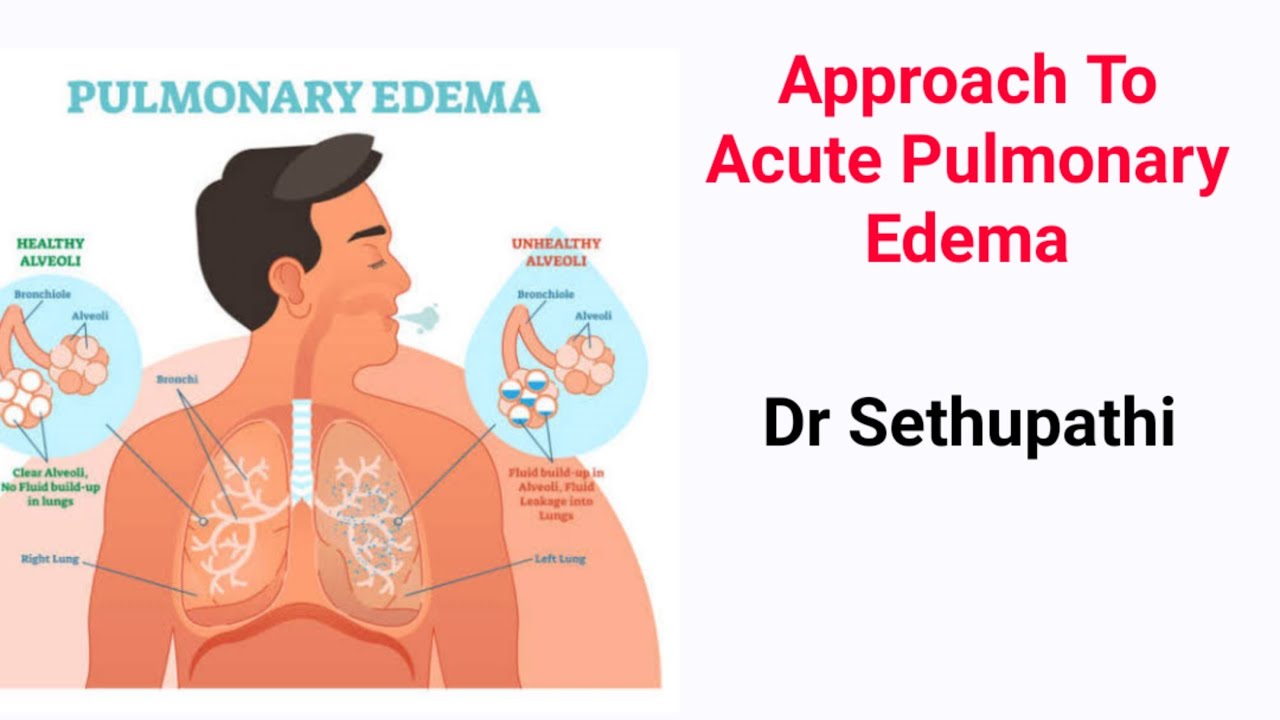 Approach To Acute Pulmonary Edema & Heart Failure Dr Sethupathi - YouTube
