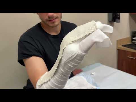 SA Plaster Radial Gutter Splint 2 Slabs