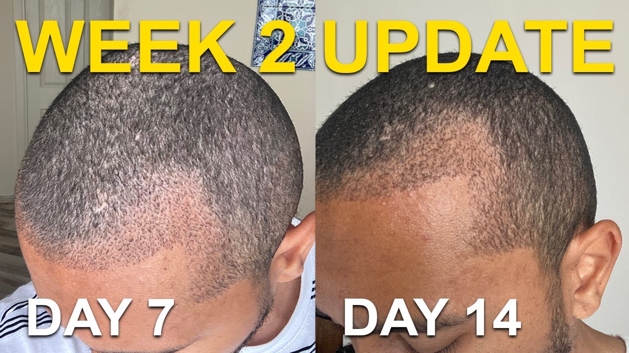 Afro Hair Transplant Week 2 Update
