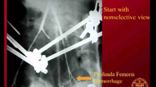 SIR-RFS Webinar (2/7/2013): Principles of Embolization in Trauma