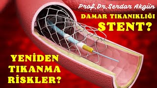 Stent neden tıkanır? Damar Tıkanıklığı, Riskler, Prof.Dr.Serdar Akgün, Serdar Akgün Videoları