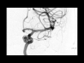 Neurointerventional Stroke Rounds  -  Aneurysm Coiling