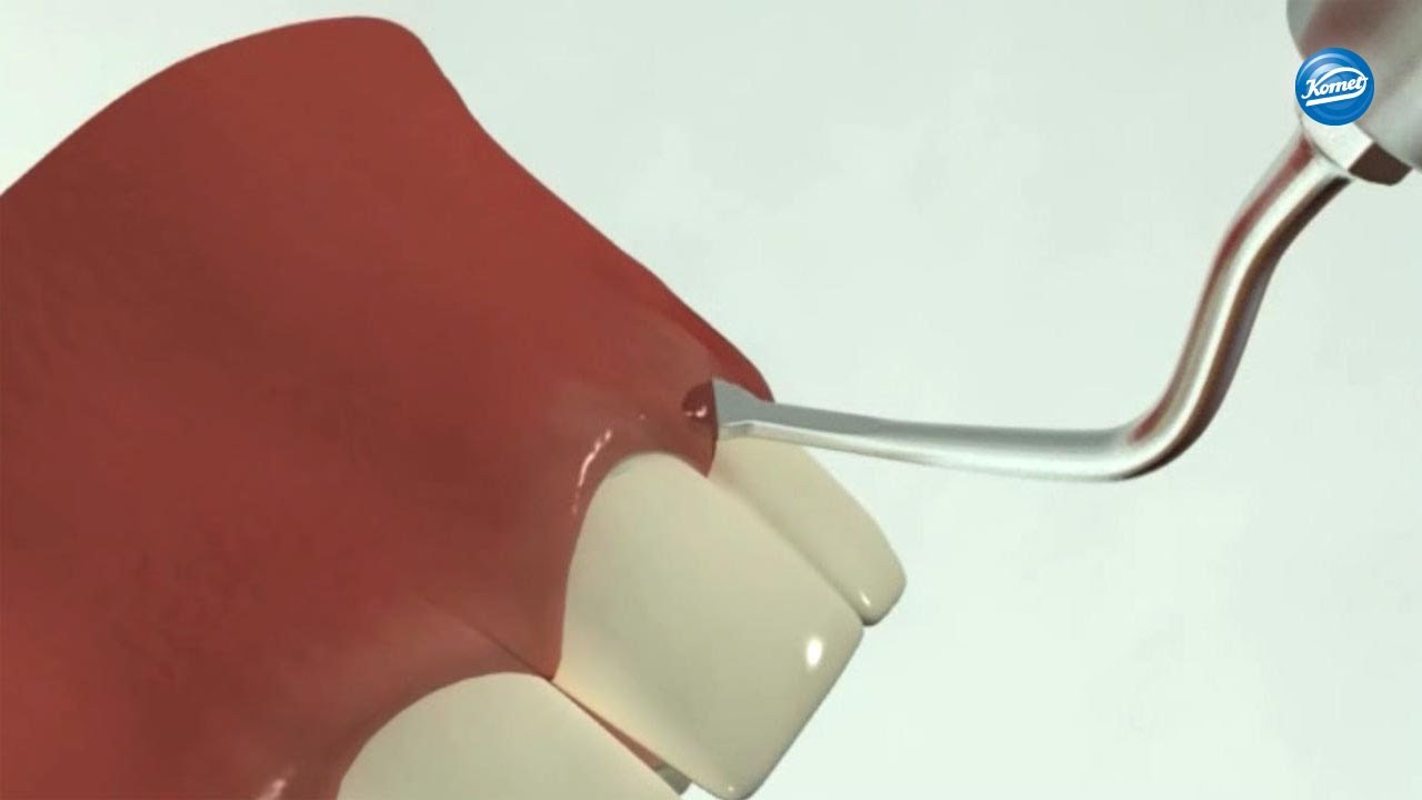 Minimalinvasive, chirurgische Kronenverlängerung mit Schallspitzen, Schematisch